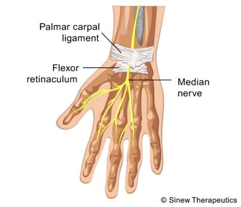 Wrist Sprain Strain Information Sinew Therapeutics