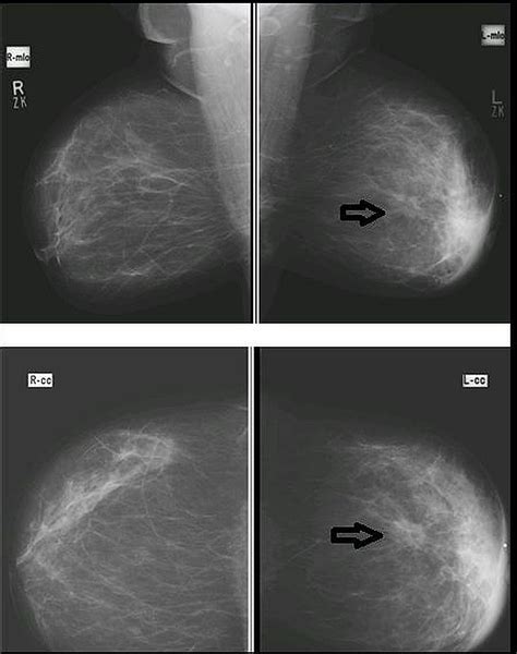 Cureus Diagnostic Accuracy Of Digital Mammography In The Detection Of