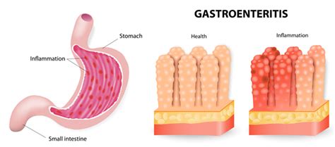 Gastroenteritis is a nonspecific term for various pathologic states of the gastrointestinal tract. La gastroenteritis