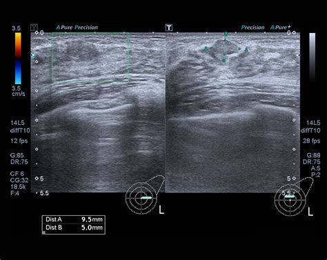Breast Ultrasound And How It Is Used To Fight Against Breast Cancer