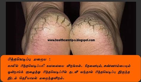 It's a common question so we've compiled healthy eating food tips to help. Healing the cracked heels natural remedy in Tamil | Health ...