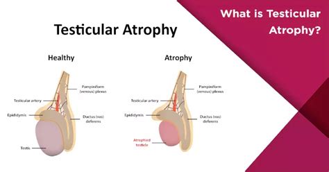 What Is Testicular Atrophy Nova Ivf