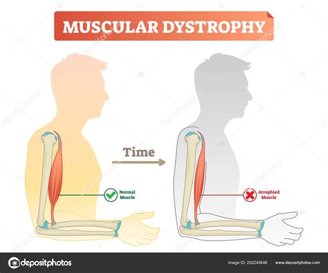 Vector Illustration About Muscular Dystrophy Compared Normal Muscle
