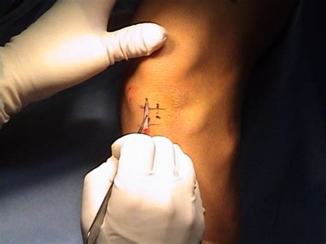 Acl Skin Incision For Patella Tendon Autograft Arizona Institute For