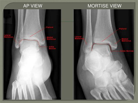 Ppt Ankle Fractures Powerpoint Presentation Free Download Id6596983