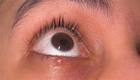 Stye On Right Bottom Eyelid 2 Months Old—have A Removal Surgery Set