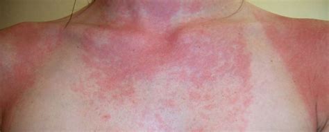 Sun Allergy Symptoms Causes And Treatment The Science Thinkers