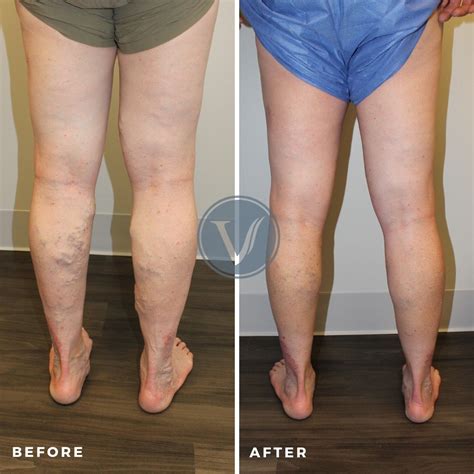 Treatment For Varicose Veins Causing Leg Pain The Vein Institute