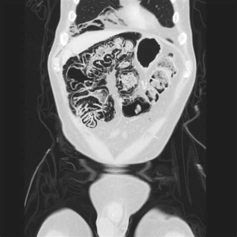 Pneumatosis Intestinalis Pacs