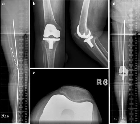 A 74 Year Female With Advanced Valgus Deformity Of The Right Knee