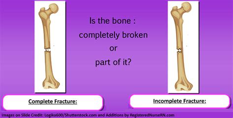 Bone Fractures Nclex Review