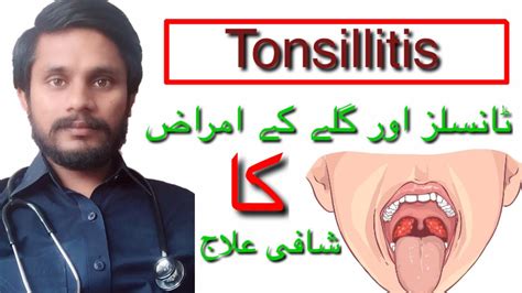 How To Treat Tonsillitis Youtube