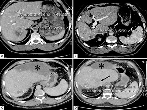 Ct Images Showing Changes In Liver Metastases A — Scan Before