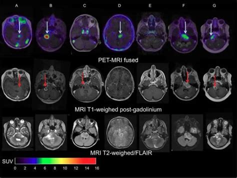 Petct Helps Predict Therapy Effectiveness In Pediatric Brain Tumors