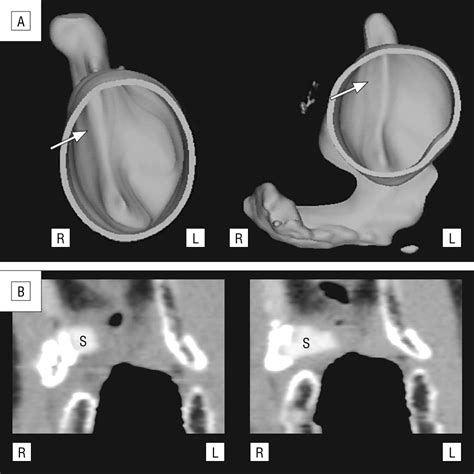 Three Dimensional Endoscopic Images Of Vocal Fold Paralysis By Computed
