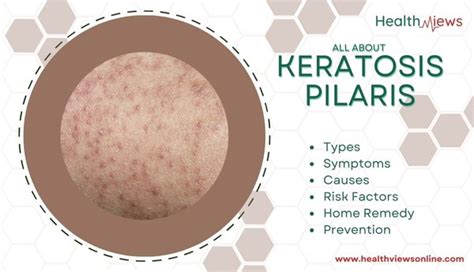 All You Need To Know About Keratosis Pilaris