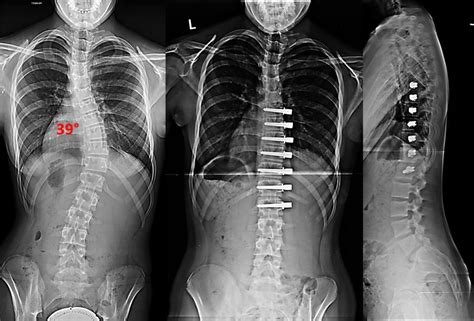 Non Fusion Corrective Scoliosis Surgery Scoliosis And Spine Associates 2023