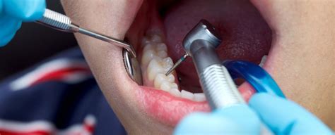 Study Of No Drill Dentistry Shows Fillings Arent Needed In Many Cases