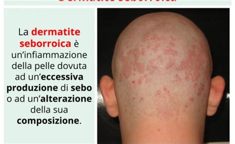 Dermatite Seborroica Cause Sintomi E Rimedi Naturali Otosection