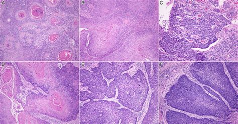 Histopathological Grading Of Oral Squamous Cell Carcinoma Showing Download Scientific Diagram