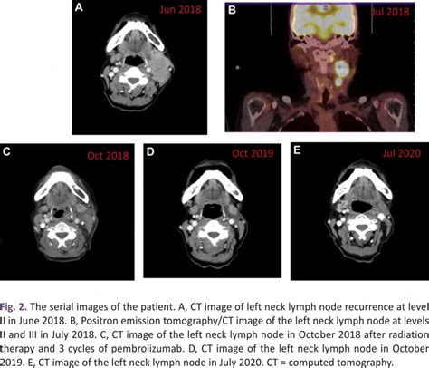Anaplastic Thyroid Cancer Successfully Treated With Radiation And