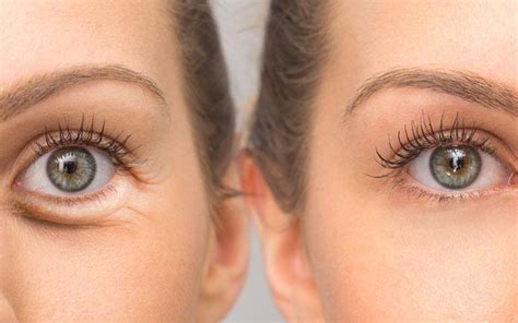 Improve Fine Lines Under Your Eyes Dermatology Care Of Charlotte