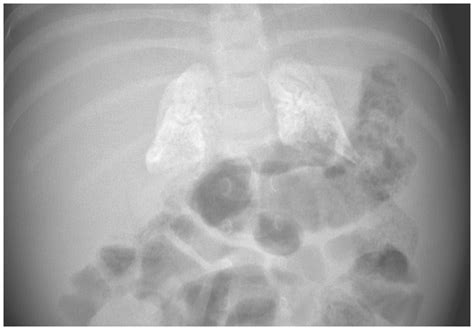 Plain Radiography Of The Abdomen Revealed Calcification Grepmed