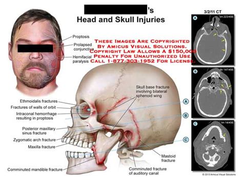 Amicus Illustration Of Amicus Injury Head Skull Proptosis Prolapsed Conjunctiva Hemifacial