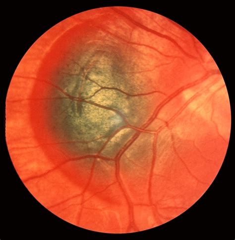 Subretinal Hemorrhage Retina Image Bank