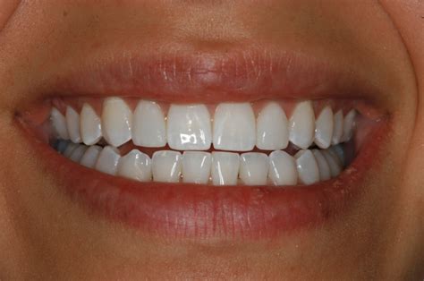 Cosmetic Dentistry And Tmj Undersized Lateral Incisors Can Corrected