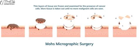 Mohs Surgery Recovery And Aftercare What To Expect Healing Time