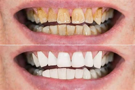 does coffee stain your teeth here s how to prevent it