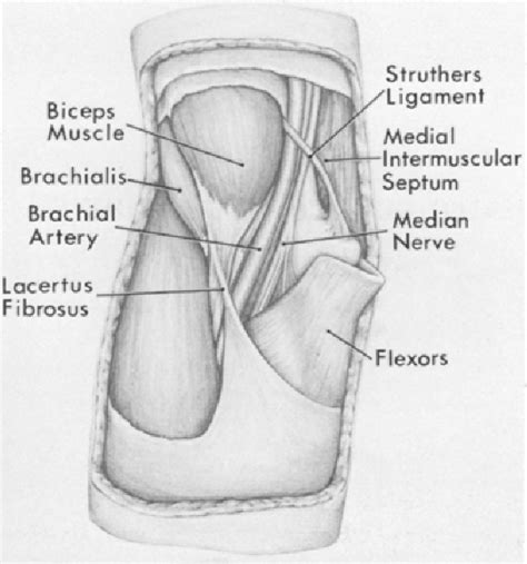 Figure 1 From Struthers Ligament A Source Of Median Nerve Compression