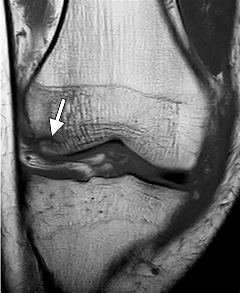 Osteochondral Lesions Of The Knee Differentiating The Most Common