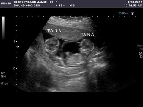 New Twin Ultrasound Pic Babycenter