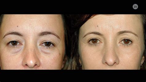 Before And After Photos Blefaroplasty