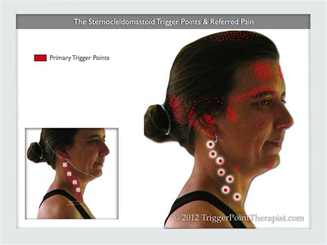 Sternocleidomastoid Trigger Points Master Of The Migraine
