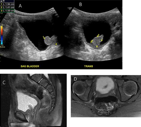 Ultrasound Imaging Of Urethral Polyp At Time Of Presentation Sagittal