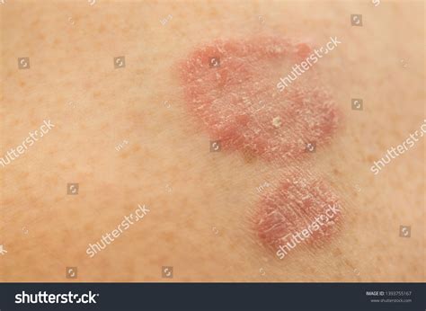 Psoriasis Skin Two Psoriatic Plaques On Stock Photo 1393755167