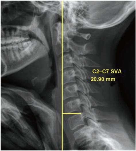 Lateral Eos Image Of The Cervical Spine Showing The Mea Open I