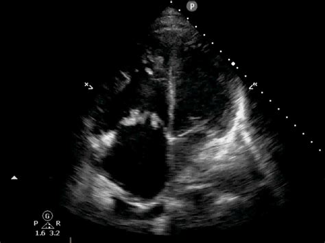 Bacterial Endocarditis Tricuspid Valve Critical Care Sonography