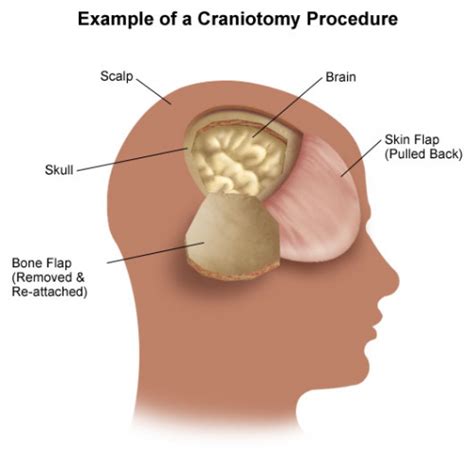 Everything You Wanted To Know About: Cranial Bone Flaps | The Trauma Pro