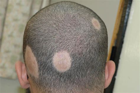 Ringworm In Hair Pictures Photos