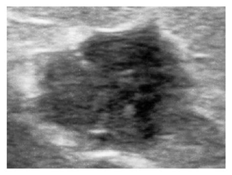 Galactocele In The Axillary Accessory Breast Mimicking Suspicious Solid