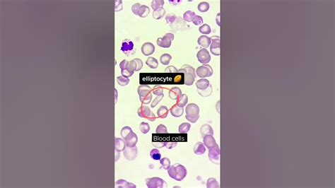 Poikilocytosis 😱😳😩 Abnormal Shaped Red Blood Cells Rbcs In The