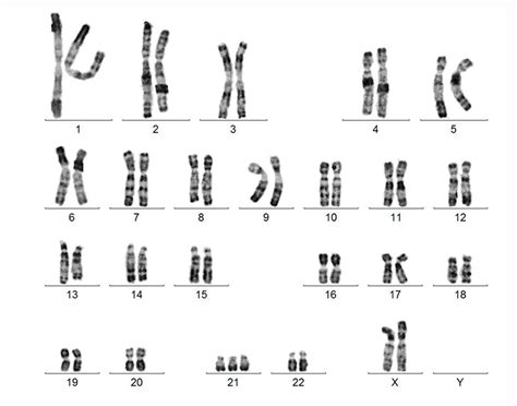 cri du chat syndrome karyotype