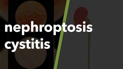 Nephroptosis Cystitis 29 Youtube