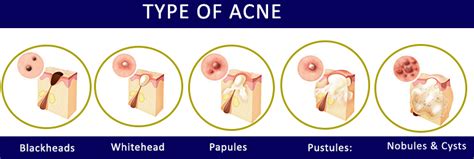 6 Best Homeopathic Medicines For Acne Pimples Blackhead Treatment