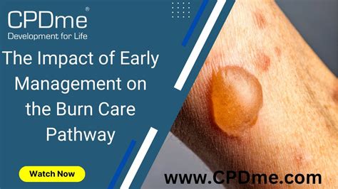 The Impact Of Early Management On The Burn Care Pathway Presented By