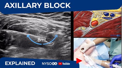 Ultrasound Guided Axillary Brachial Plexus Block Nysora Regional